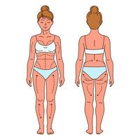 Female Body Liposuction Markings Front and Back. illustration showing front and back view of a womans body with marked areas for liposuction and body contouring vector
