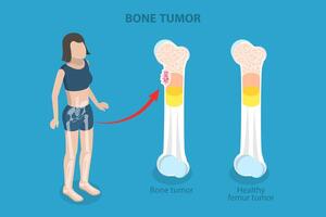 3D Isometric Flat Illustration of Bone Tumor, Orthopedic Problem vector