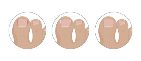 Ingrown toenail surgery using a tamponade, three steps of healing process vector