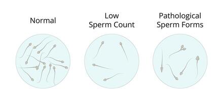 Normal, low and pathological sperm count showing different sperm forms vector