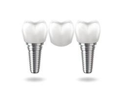 Illustration of three dental implants in realistic style, metallic and white colors, representing oral care and dental procedures, on a white background with copy space. vector