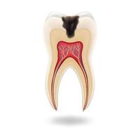 Detailed illustration of tooth anatomy showing decay in realistic style. Colors emphasize pulp and dentin with visual focus on decay. Educational tool for dentistry studies with copy space. vector
