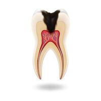 Illustration showing crosssection of tooth with decay and nerves visible, educational purpose, isolated on white background, dental health, with copy space vector