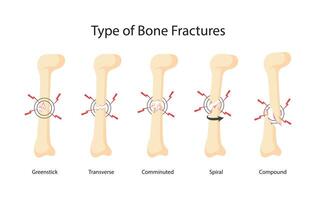 set of various bone fractures illustrations vector