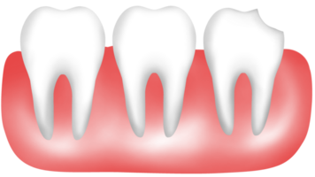 Human tooth anatomy with chipped and broken features png