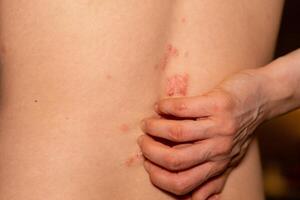 psoriasis patches visible on the back with hand touching itchy areas in a close up view photo