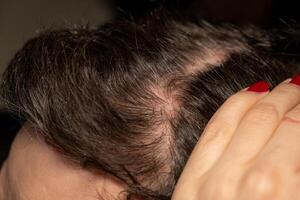 Scalp affected by psoriasis showing red patches and scaly skin in close up view photo