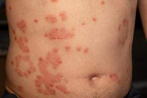 Understanding psoriasis through visible skin patches that are red, itchy, and scaly on the abdomen photo