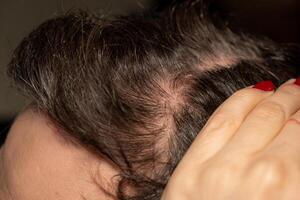 Scalp psoriasis characterized by red patches and scaly skin highlighting a common genetic immune condition photo