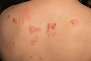 Skin patches affected by psoriasis display red, itchy, and scaly texture on the back of an individual in a clinical setting photo