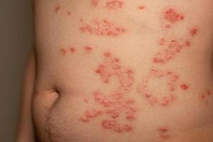 Red scaly patches on skin indicating psoriasis condition affecting the abdomen of an individual photo
