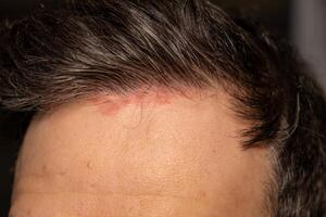 Skin patches appear on the scalp of a person suffering from psoriasis, reflecting the struggles of this chronic condition photo