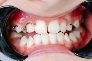 Close-up of dental appliance correcting teeth alignment during orthodontic treatment photo