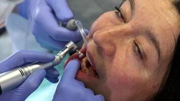 Dentist expertly changes the brush of a prophy cup during a dental procedure video