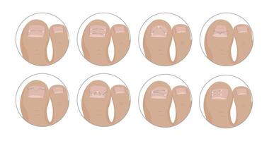 Podiatrist applying different kinds of metallic threads for ingrown toenail correction vector