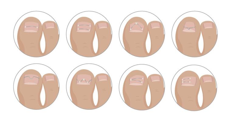 Podiatrist applying different kinds of metallic threads for ingrown toenail correction