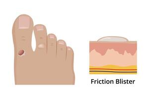Friction blister forming on foot and its anatomical structure vector