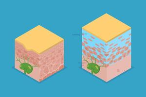 3D Isometric Flat Illustration of Lymphedema, Disorder of Lymphatic System vector