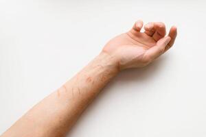 Scratched hand on a white background, top view. Skin lesions from cat claws photo