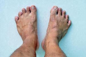 Detailed close-up image of a man's bare feet showing visible bunions and natural imperfections photo