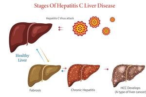 Diagram Illustration Showing Stages of Hepatitis C Liver Disease Progression vector