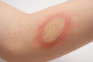 A red ring-shaped skin rash with central clearing, indicating a possible fungal infection or irritation on a human arm photo