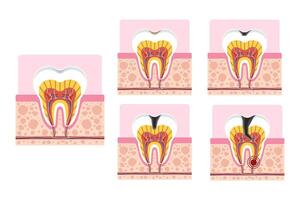 Stages of tooth decay showing enamel, dentin, and pulp involvement. Dental health illustration. vector