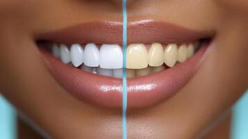 Comparison of teeth whitening results showcasing contrasting shades for effective dental care visibility photo