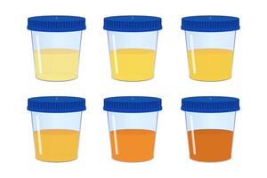 Medical urine test showing different colors, indicating various health conditions vector