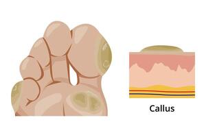 Callus forming on sole of foot and its anatomical structure vector