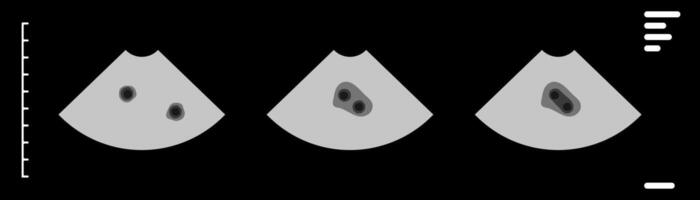 Ultrasound scan showing triplets during pregnancy monitoring vector