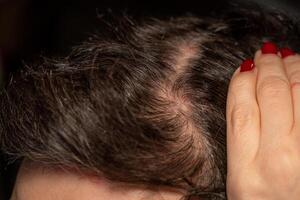 Uncovering psoriatic patches on the scalp highlighting symptoms and challenges of skin conditions photo