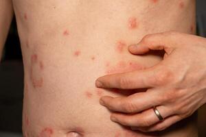 Skin patches indicative of psoriasis observed on a persons abdomen showcasing red, itchy, and scaly symptoms photo
