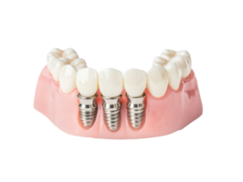 Dental implants for restoring smiles and improving oral health png
