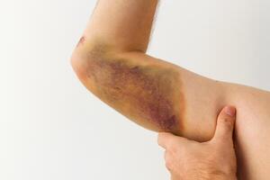 Injured arm with significant bruising highlighting the impact of a physical encounter photo