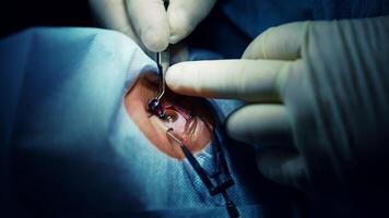 Treatment of eye. Operation in eye to a patient. Professional doctor performs ophthalmological procedure on eye with special medical instrument. Close-up. video