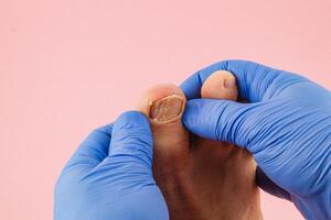 Caring for a toenail while wearing blue gloves photo