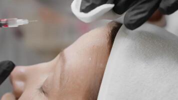 A skilled medical professional administers a precise botulinum toxin injection into the forehead to reduce wrinkles and improve skin appearance, enhancing its youthful look and radiance video