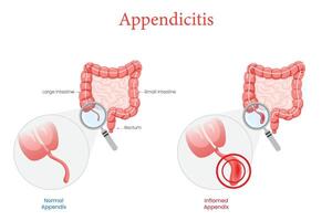 Diagram of Normal and Inflamed Appendix Showing Appendicitis Differences vector
