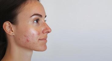 Profile view characterized a young woman displaying problematic skin of by acne, pimples redness, and various blemishes on her face photo