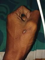 Close-up of a skin lesion on a hand photo