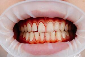 Dentist examining patient teeth using cheek retractor during dental procedure photo