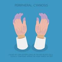 3D Isometric Flat Illustration of Peripheral Cyanosis Symptoms, Low Oxygen Levels in Extremities vector