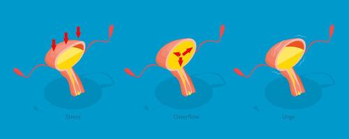 3D Isometric Flat Illustration of Urinary Incontinence, Diagram Outlining Different Types of Incontinence Problems. Stress, Overflow, and Urge vector
