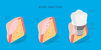 3D Isometric Flat Illustration of Bone Grafting, Understanding of Teeth Structure for Successful Treatment vector