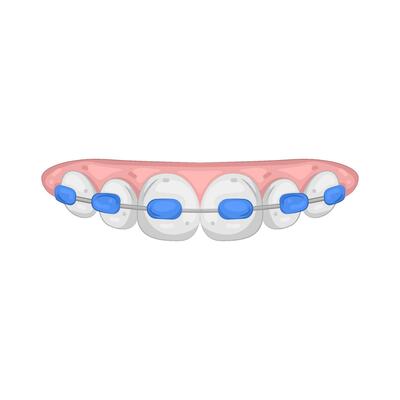 Illustration of Dental Braces