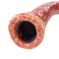 Detailed 3D rendering of a human colon with polyps, showcasing colon cancer and digestive health on a transparent background png
