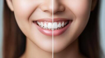 Comparison of teeth whitening results on a person's smile. photo