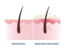 Comparison of normal skin and Seborrheic Dermatitis illustration. Cross section of Sebderm, inflamed, red patches with a greasy scale and flakes over of the skin. Skin care and disorder concept. vector