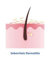 Seborrheic Dermatitis on skin layer illustration. Cross section of Sebderm, inflamed, red patches with a greasy scale and flakes over the oilier areas of the skin. Skin care and beauty concept. vector